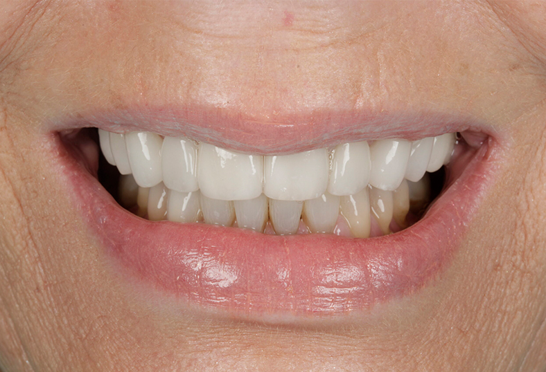 After - Ibbott Dental