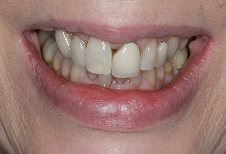 Before - Ibbott Dental