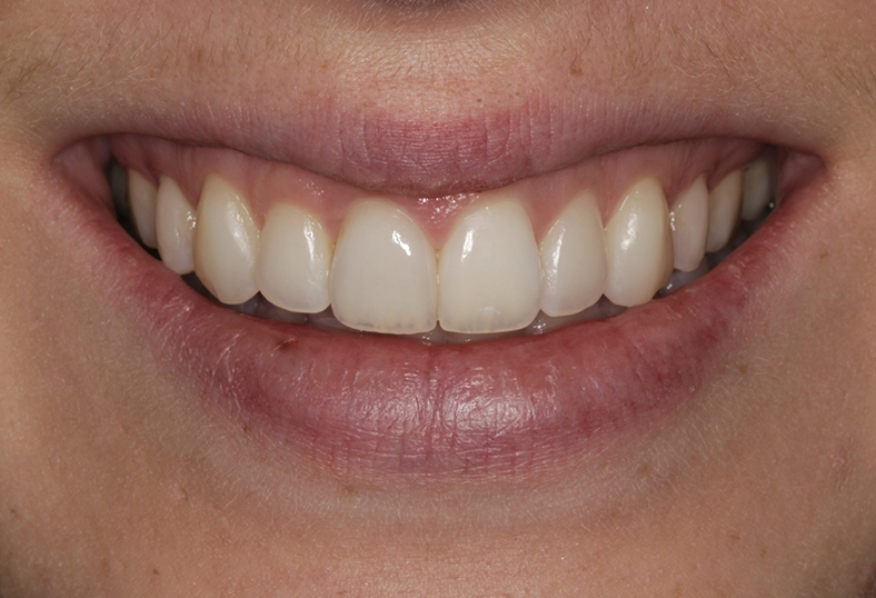 After - Ibbott Dental