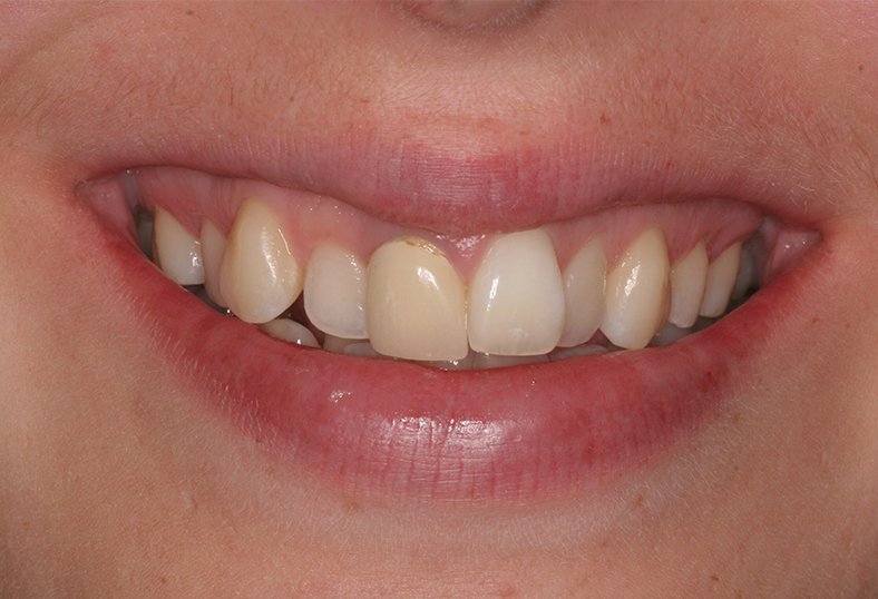 Before - Ibbott Dental