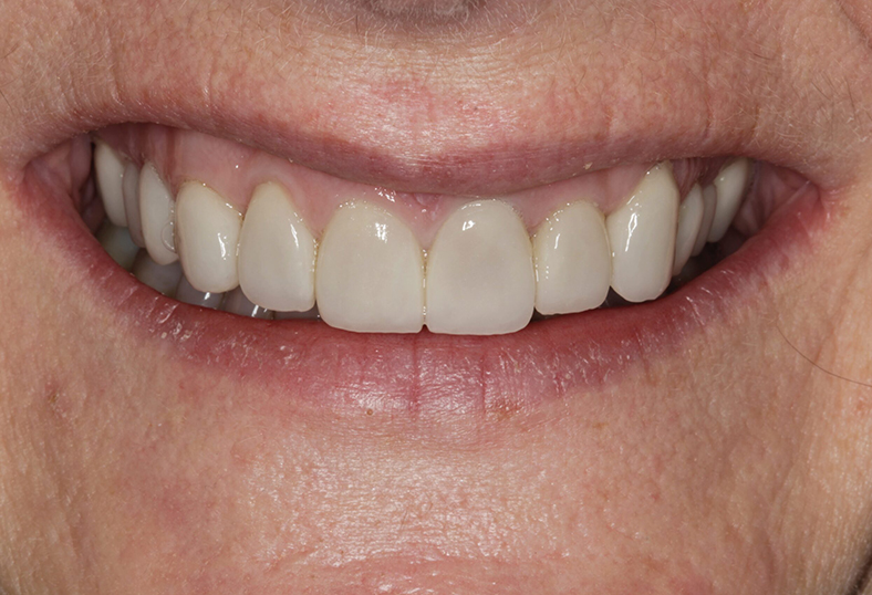 After - Ibbott Dental