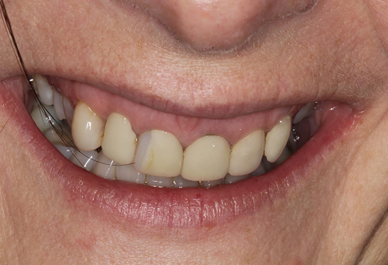 Before - Ibbott Dental