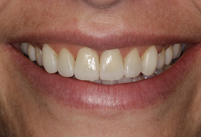 After - Ibbott Dental