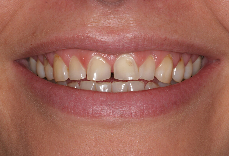 Before - Ibbott Dental