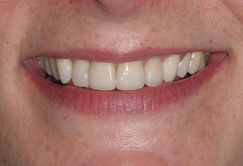 After - Ibbott Dental