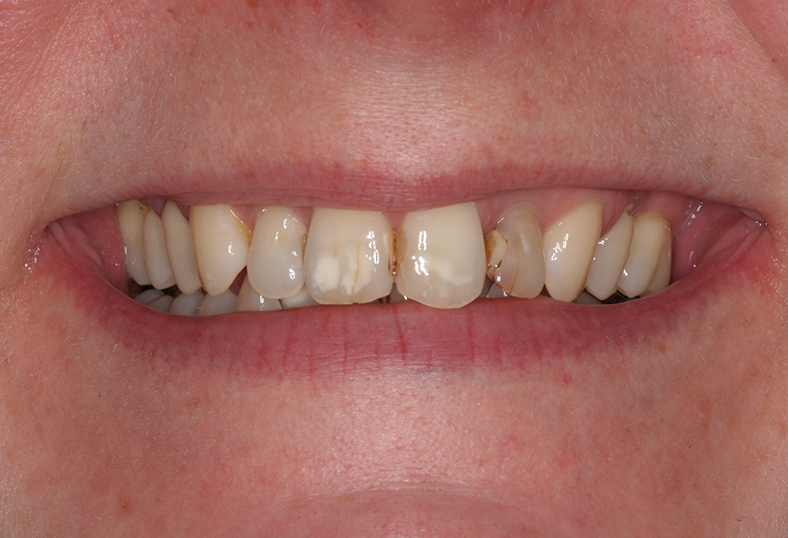 Before - Ibbott Dental