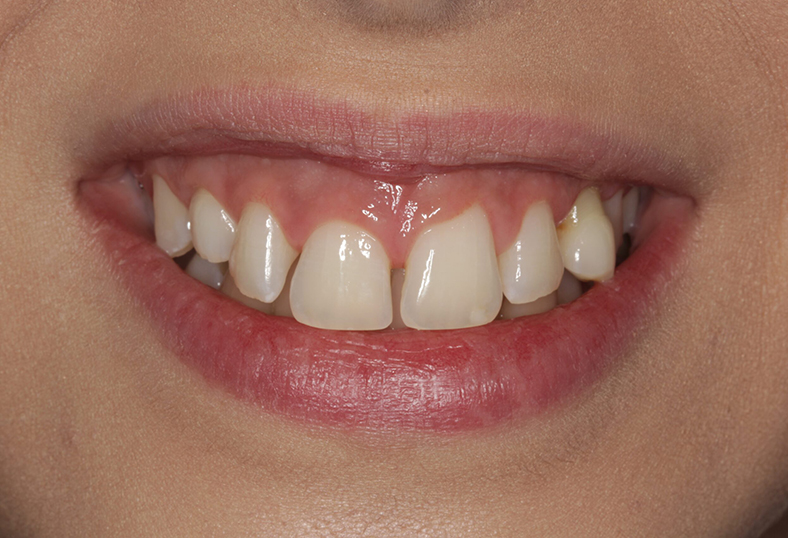 Before - Ibbott Dental