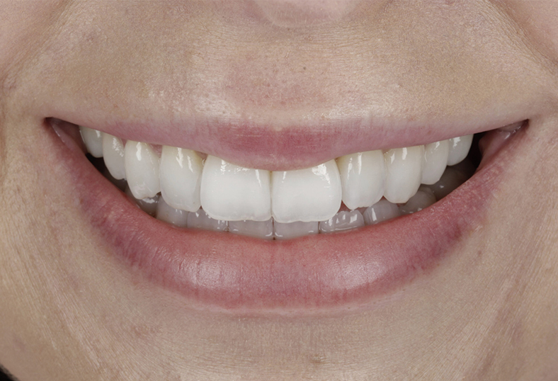 After - Ibbott Dental