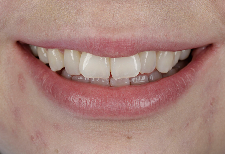 Before - Ibbott Dental