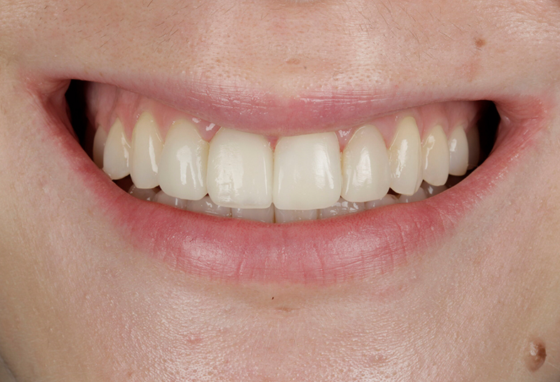 After - Ibbott Dental