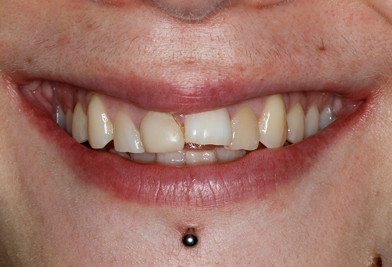 Before - Ibbott Dental