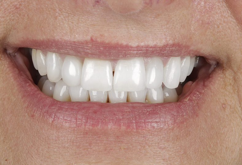 After - Ibbott Dental