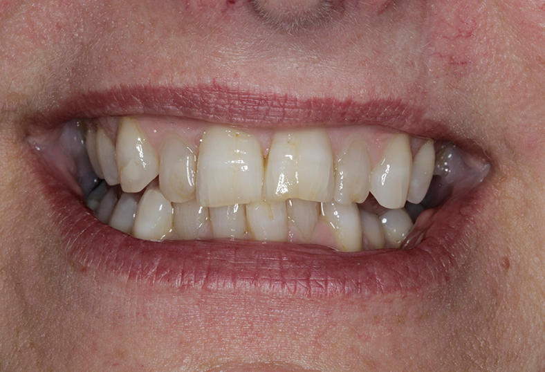 Before - Ibbott Dental