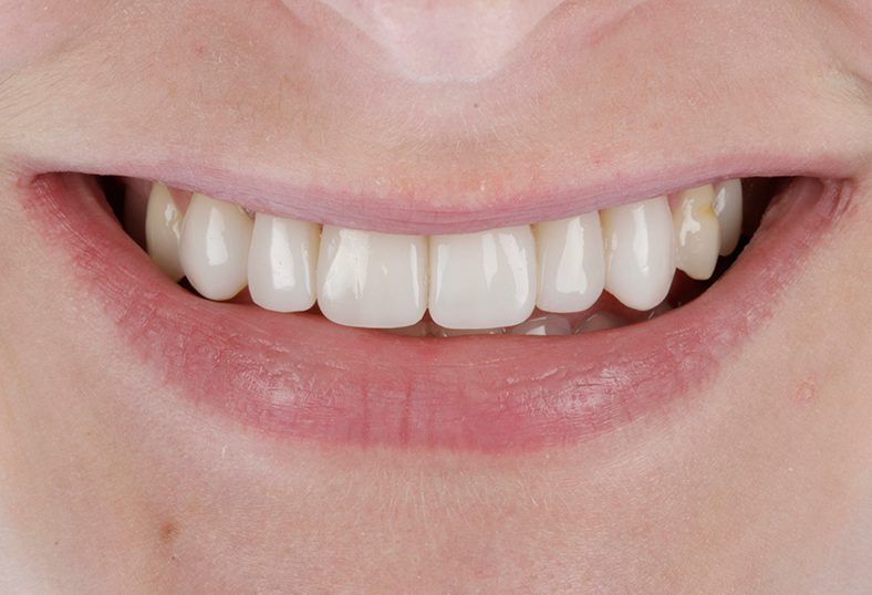 After - Ibbott Dental