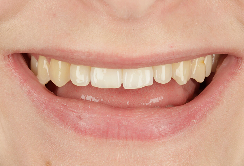 Before - Ibbott Dental