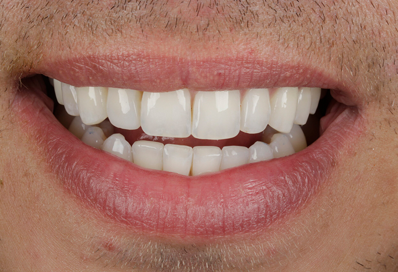 After - Ibbott Dental