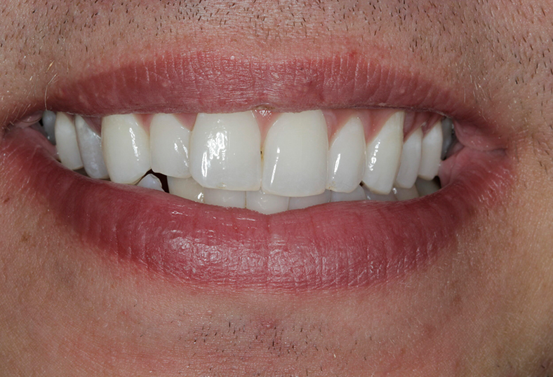 Before - Ibbott Dental