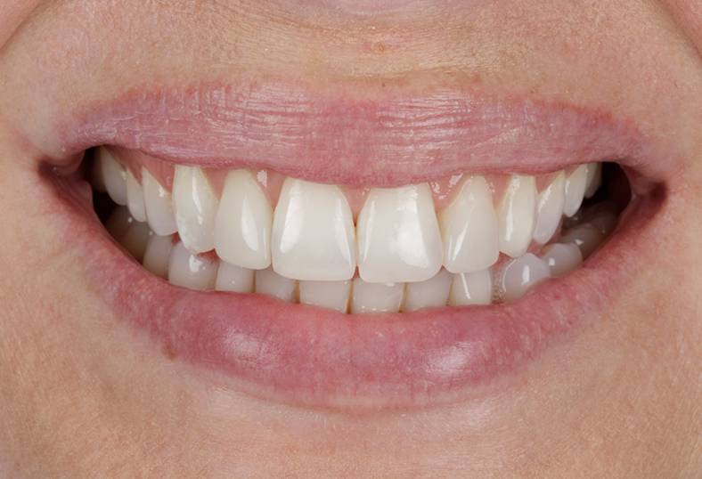 After - Ibbott Dental