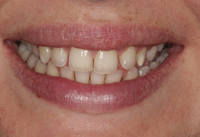 Before - Ibbott Dental