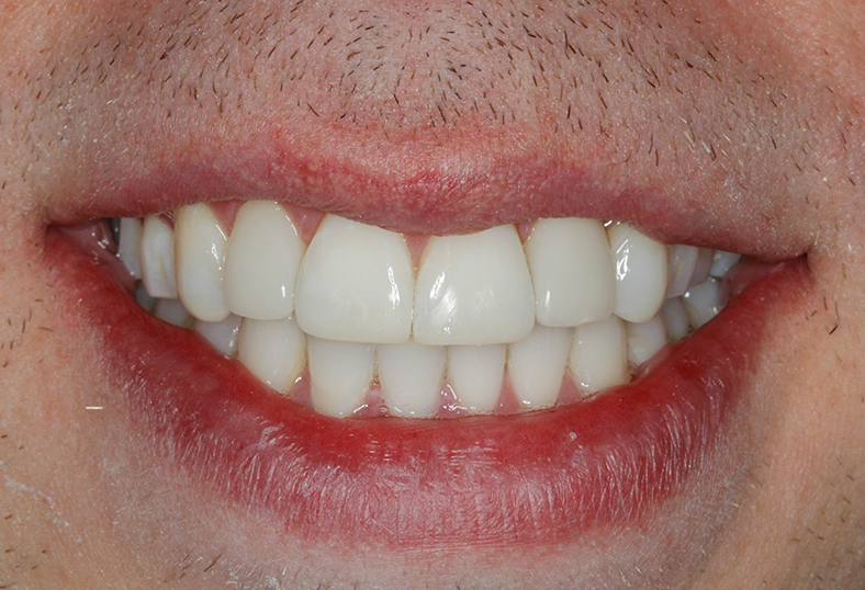 After - Ibbott Dental