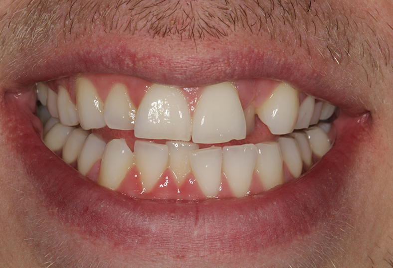 Before - Ibbott Dental