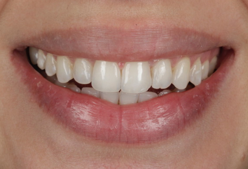 After - Ibbott Dental