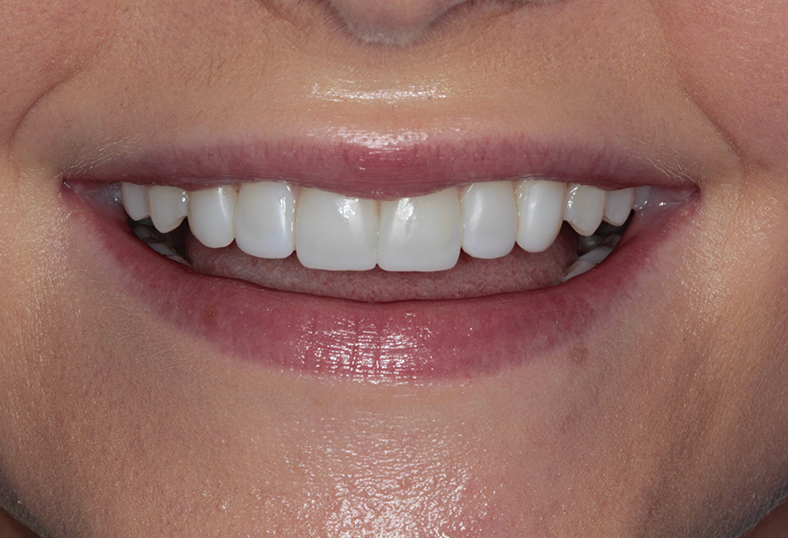 After - Ibbott Dental