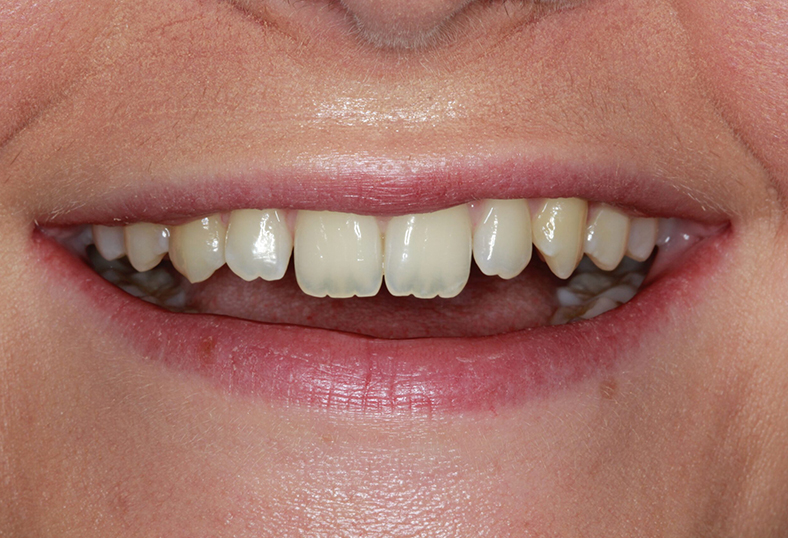 Before - Ibbott Dental