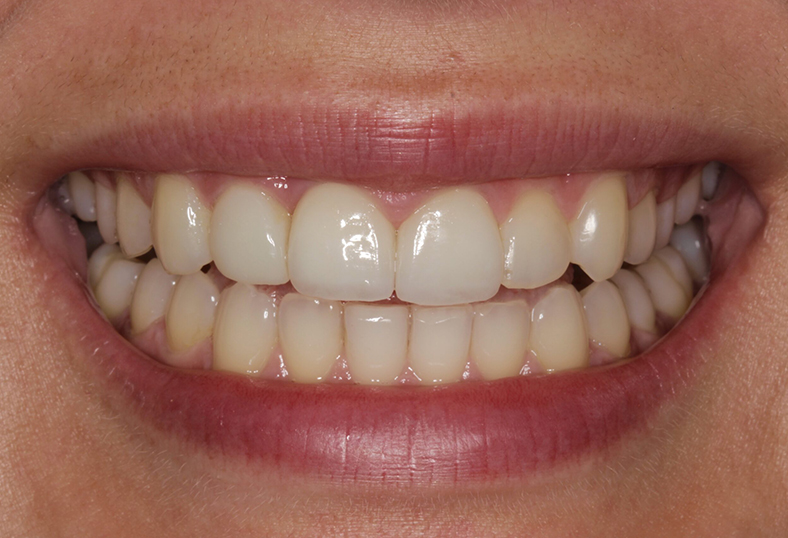 After - Ibbott Dental