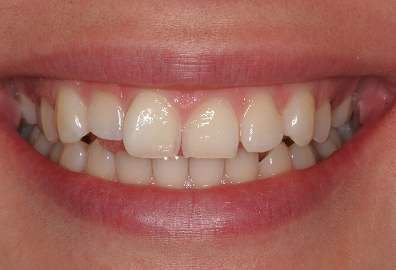 Before - Ibbott Dental