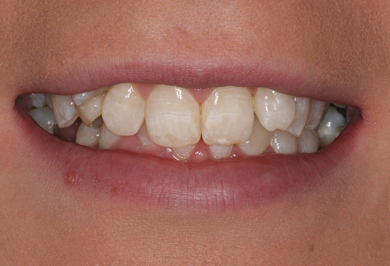 Before - Ibbott Dental