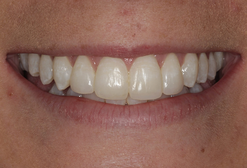 After - Ibbott Dental