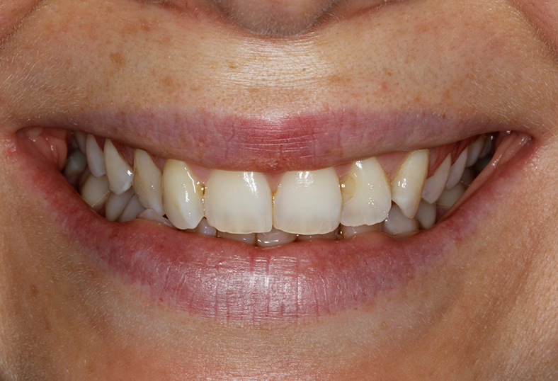 Before - Ibbott Dental