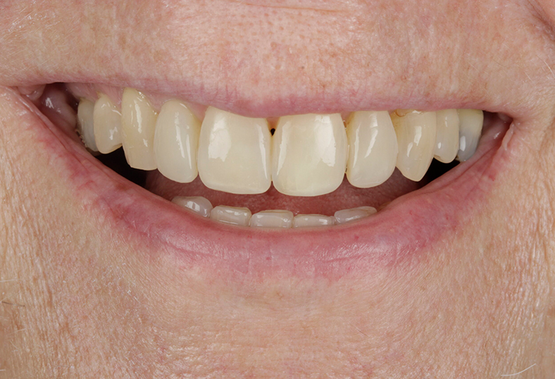 After - Ibbott Dental