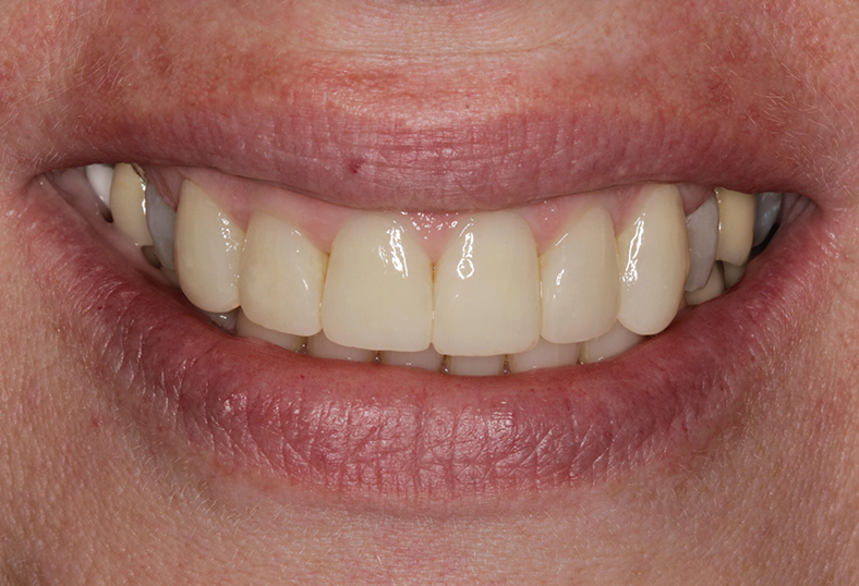 After - Ibbott Dental