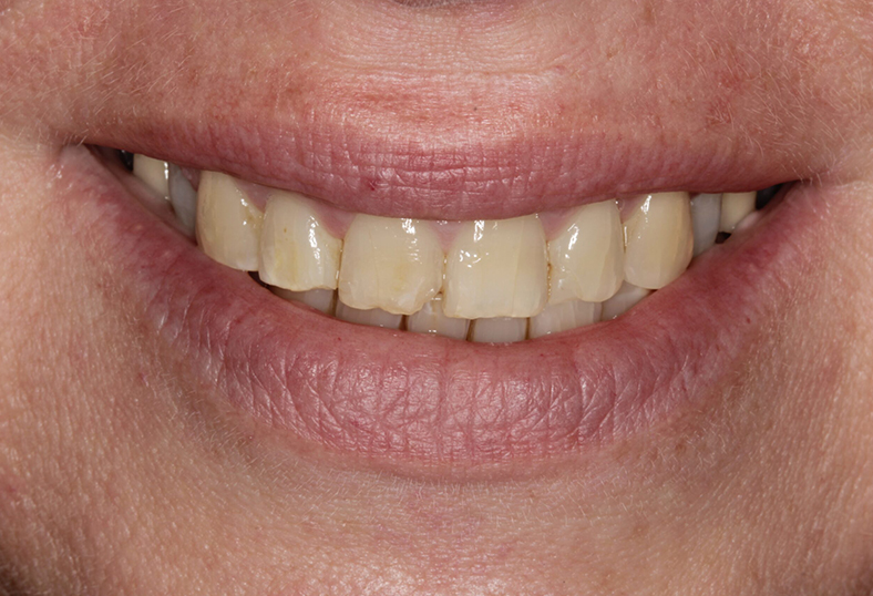 Before - Ibbott Dental