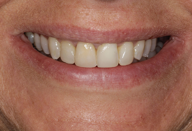 After - Ibbott Dental