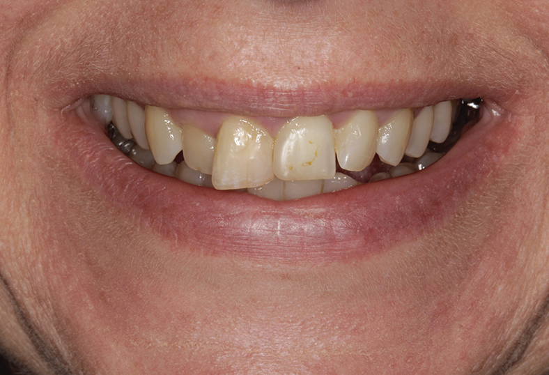 Before - Ibbott Dental