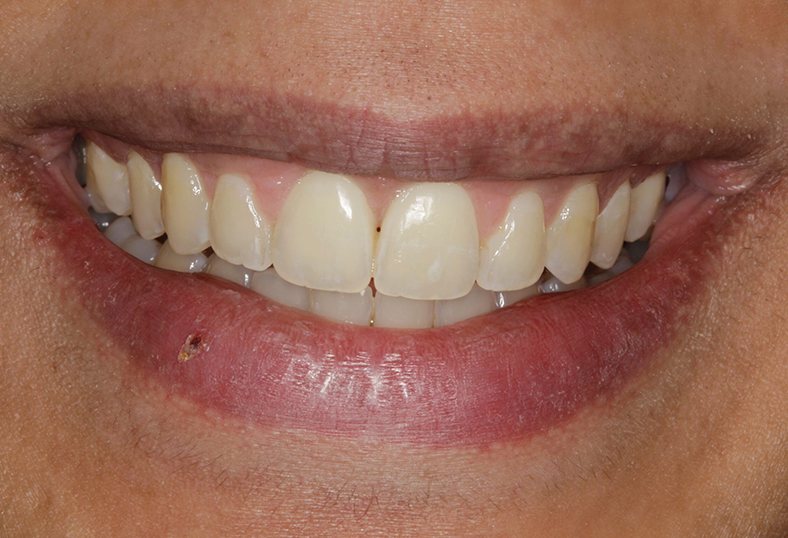 After - Ibbott Dental