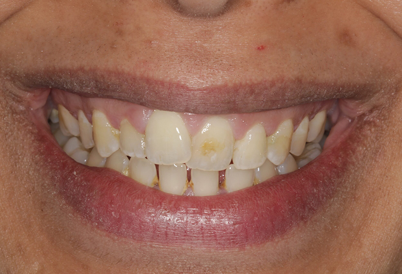 Before - Ibbott Dental