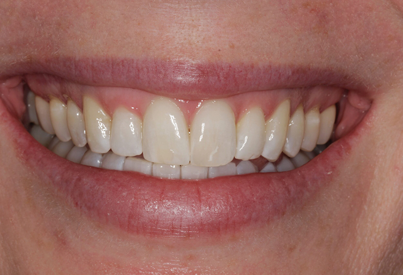 After - Ibbott Dental