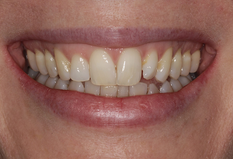 Before - Ibbott Dental