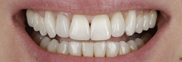 After - Ibbott Dental 