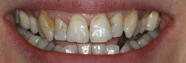Before - Ibbott Dental
