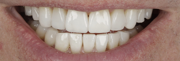 After - Ibbott Dental 