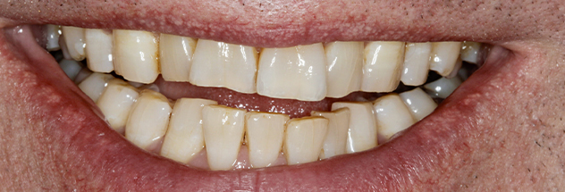 Before - Ibbott Dental