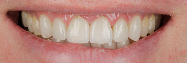 After - Ibbott Dental 