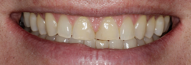 Before - Ibbott Dental