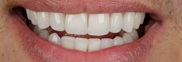 After - Ibbott Dental 