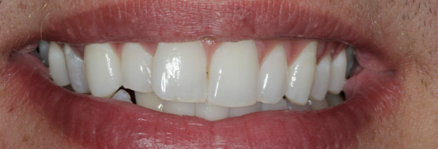 Before - Ibbott Dental